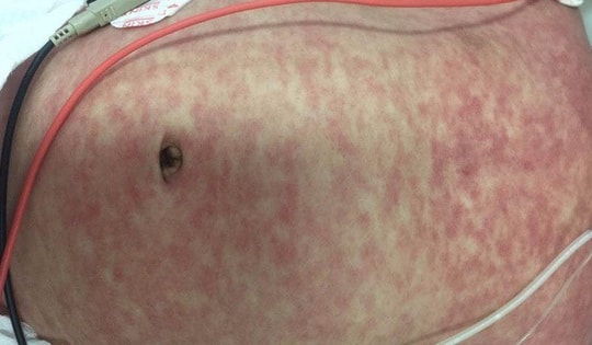 Bé gái 4 tuổi ở Hà Nội tử vong do sởi, bác sĩ khuyến cáo dấu hiệu cần đưa trẻ đi viện ngay