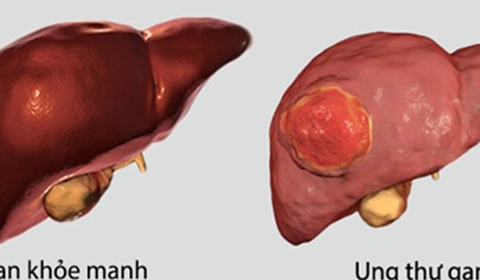 Đi khám vì mệt mỏi, đau tức ngực, người đàn ông 60 tuổi bất ngờ phát hiện ung thư gan