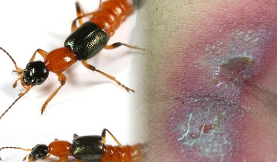 Toàn thân tổn thương, chảy dịch vùng sinh dục do đắp kiến ba khoang chữa ngứa