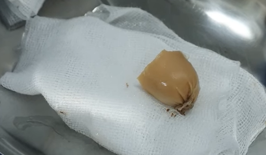 Đang ăn xúc xích, bé gái 13 tuổi phải đi cấp cứu vì lý do này