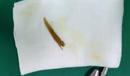 Nuốt phải xương gà, nhiều người bị thủng ruột non