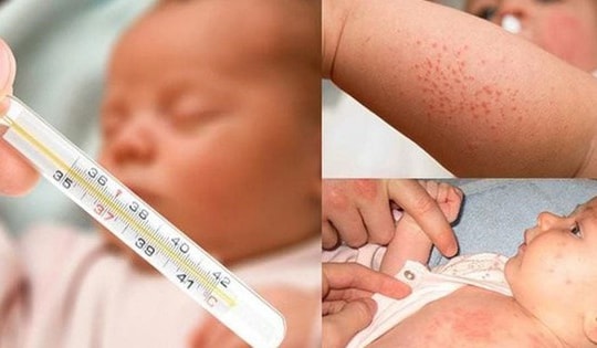 Thuốc điều trị viêm tai giữa do bệnh sởi