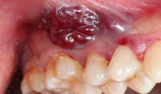 8 dấu hiệu cảnh báo ung thư khoang miệng