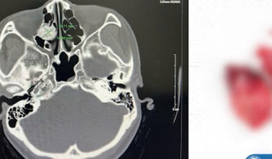 Đau đầu âm ỉ, người phụ nữ 43 tuổi ở Vĩnh Phúc đi khám bất ngờ phát hiện u xương