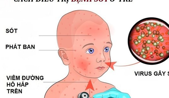 Dùng thuốc điều trị sởi và viêm não do bệnh sởi