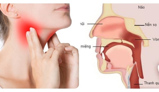 Các yếu tố nguy cơ gây ung thư vòm họng ở phụ nữ