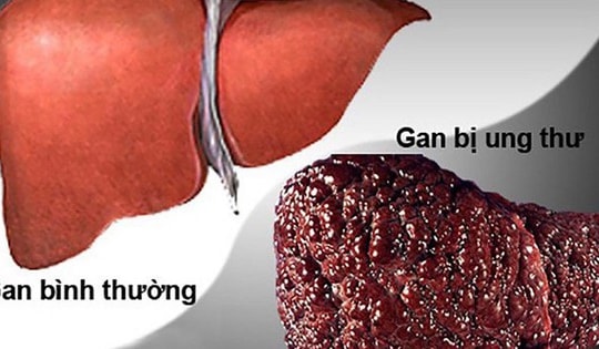 Lên mạng tìm thầy chữa ung thư gan, người đàn ông 37 tuổi ở Hà Nội qua đời trong sự đau xót của người thân