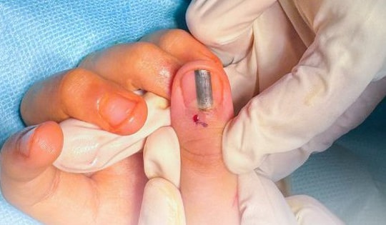 Xuất hiện vệt đen trong móng tay nghi ung thư da, bé 10 tuổi đi khám bất ngờ nhận tin vui