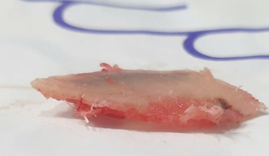 Người đàn ông bị xương sườn đâm thủng phổi