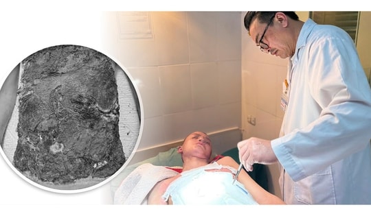 Nhiễm trùng nặng do điều trị bỏng bằng thuốc nam