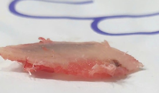 Tưởng chỉ xây xước nhẹ, bệnh nhân suýt mất mạng vì gãy xương sườn