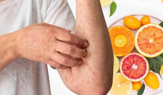 10 lưu ý về chế độ dinh dưỡng cho bệnh sởi