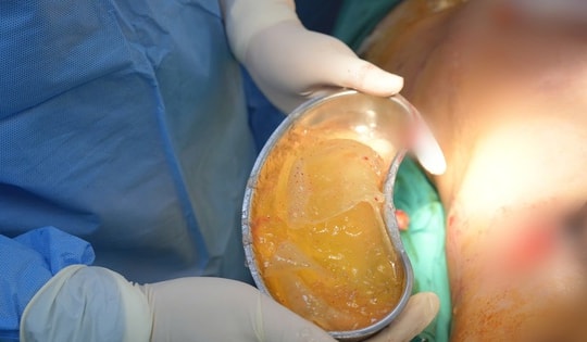 Hy hữu: Người phụ nữ bị vỡ túi nâng ngực khi đang mang thai