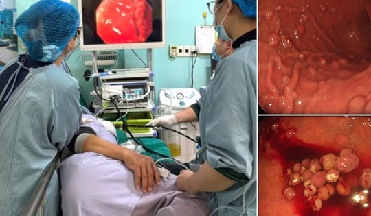 Đau bụng, ợ hơi, người phụ nữ 48 tuổi đi khám phát hiện hơn 100 polyp mọc chi chít trong dạ dày
