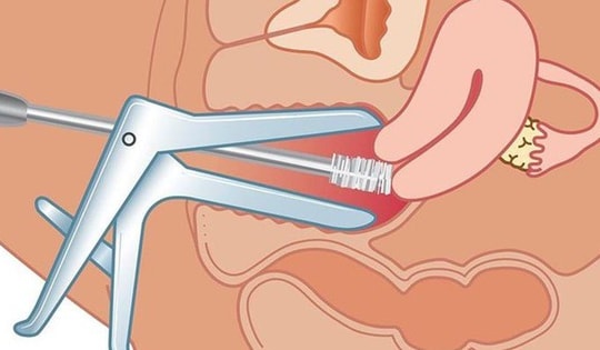 Người phụ nữ 35 tuổi đang khỏe mạnh bỗng phát hiện sớm ung thư cổ tử cung nhờ làm việc này