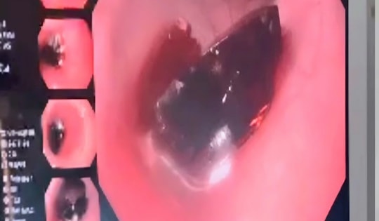 Bé trai 11 tháng tuổi nuốt mảnh vỡ ống thuốc, dị vật cắm sâu vào thực quản