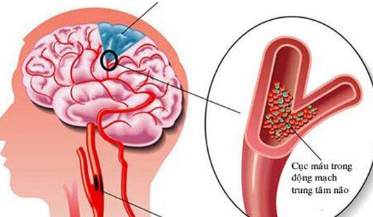 Người đàn ông ở Hà Nội phát hiện nhồi máu não từ dấu hiệu nhiều người Việt bỏ qua