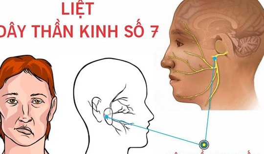 Thanh niên 27 tuổi ở Hà Nội bất ngờ bị liệt nửa mặt, bác sĩ chỉ rõ 'thủ phạm'