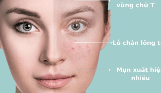 Cách làm đẹp cho da dầu, có mụn ẩn