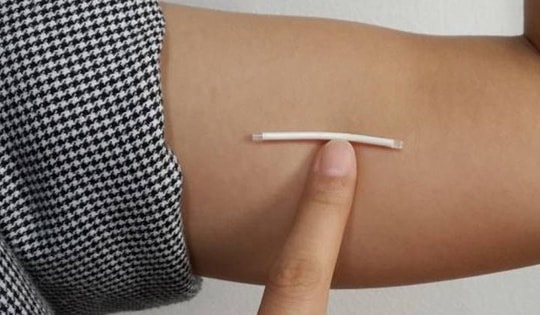 Cấy que tránh thai bao lâu thì có tác dụng?