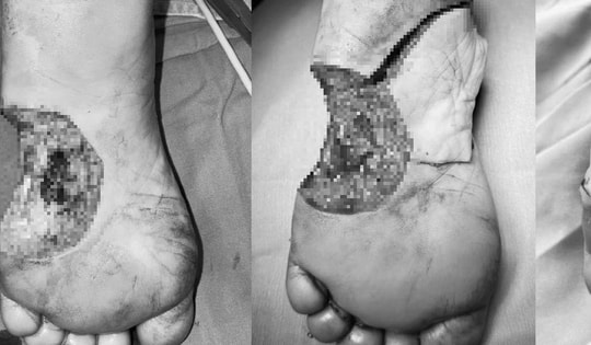 Người phụ nữ ở Hà Nội suýt phải cắt cụt chân chỉ vì một nốt ruồi nhỏ