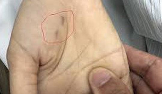 Sở Y tế Hoà Bình thông tin về ca bệnh dại tử vong