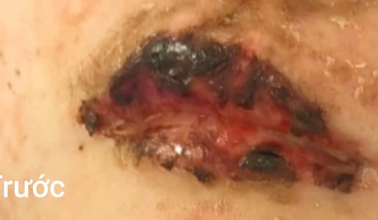 Môi tím đen như trúng độc sau một ngày tự uống thuốc cảm