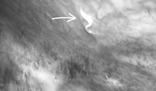 Cấp cứu thành công ca viêm ruột thừa do giun kim gây biến chứng viêm phúc mạc