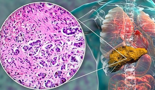 Người đàn ông 41 tuổi phát hiện xơ gan thừa nhận một sai lầm nhiều người Việt mắc phải