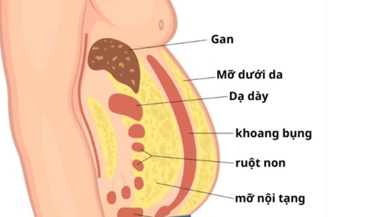4 triệu chứng mỡ nội tạng dư thừa và 4 thực phẩm là khắc tinh của mỡ
