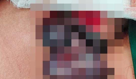 Bác sĩ 'căng não' xử lý ca bệnh phức tạp, giữ lại cơ hội sinh sản cho nam thanh niên 20 tuổi ở Hà Nội