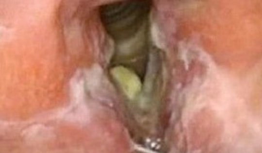 Thuốc điều trị lao thanh quản