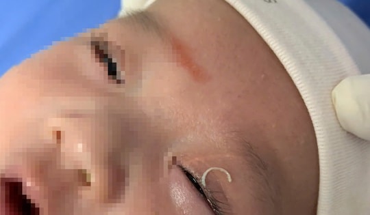 Hy hữu: Mẹ cắt móng tay khiến dị vật rơi vào mắt con 2 tháng tuổi