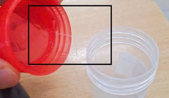 Hiếm gặp: Phát hiện ký sinh trùng dài gần 10cm trong mắt của bệnh nhân nữ