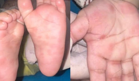 Nốt đỏ lòng bàn tay hé lộ căn bệnh nguy hiểm ở bé 4 tháng tuổi
