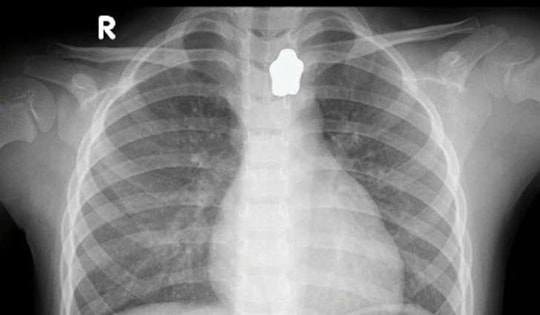 Bé gái 5 tuổi nuốt nam châm đồ chơi trong lúc ăn cơm