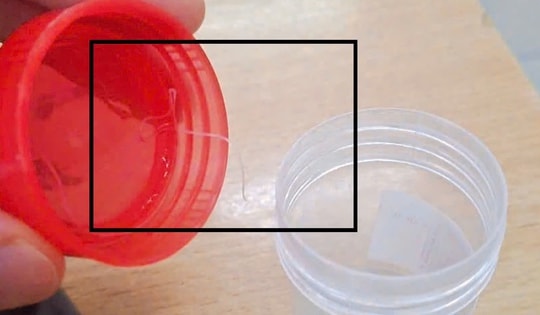 Đau nhức mắt, người phụ nữ bất ngờ phát hiện ký sinh trùng 'làm tổ' trong mắt