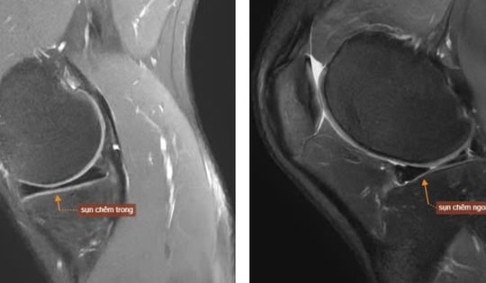 Nam thanh niên 22 tuổi ở Hà Nội suýt mất khả năng vận động vì chủ quan với dấu hiệu này trong lúc chơi thể thao