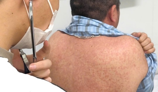 Nhiều người lớn mắc sởi biến chứng nặng