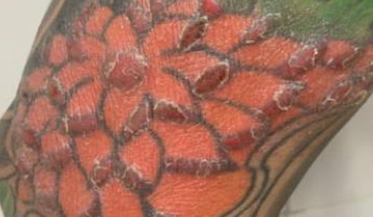 Nam thanh niên nhập viện sau khi xăm hình nghệ thuật kín 2 cẳng chân