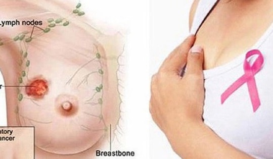 Thấy bất thường ở ngực, người phụ nữ 38 tuổi ở Hà Nội đi khám bất ngờ phát hiện khối u hiếm gặp