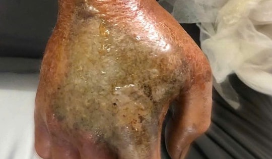 Cứu bàn tay người đàn ông bị rắn cắn