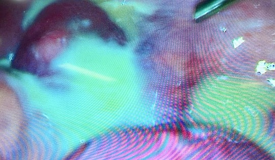 Phẫu thuật thành công cho một phụ nữ có vòi trứng, buồng trứng chứa đầy mủ trắng