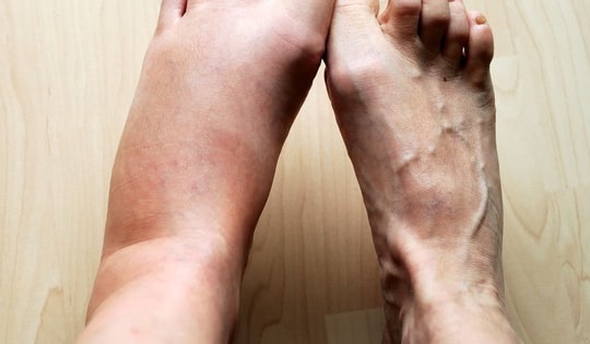 Các thuốc gây phù chân, xử trí như thế nào?