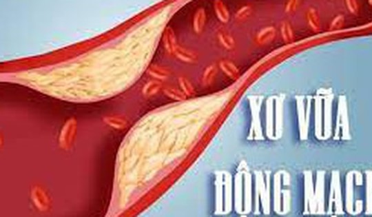 Một số thuốc và phương pháp điều trị xơ vữa động mạch