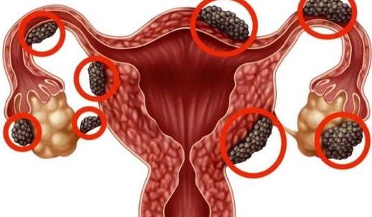 Người phụ nữ 47 tuổi ở Bắc Ninh phải nhập viện phẫu thuật cắt tử cung từ dấu hiệu nhiều chị em Việt mắc phải