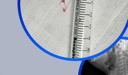 Hóc xương cá vào đường thở, bé 16 tháng tuổi nhập viện khẩn cấp