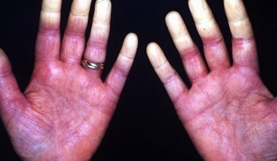 Một số thuốc và phương pháp điều trị Hội chứng Raynaud