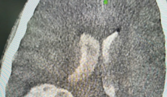 Nam sinh 14 tuổi ở Hà Tĩnh bị xuất huyết não nguy kịch, bác sĩ cho lời khuyên phát hiện sớm