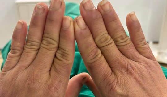 Người phụ nữ đau đớn mỗi khi chạm tay vào nước, nguyên nhân từ... hội chứng lạ